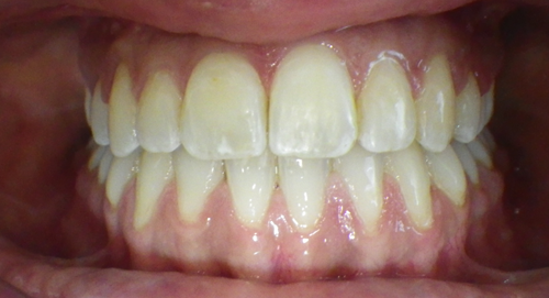 Sandton Invisalign