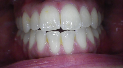 Johannesburg Invisalign